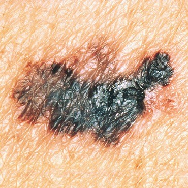 Have mole checked for cancer in Carlisle, Cumbria