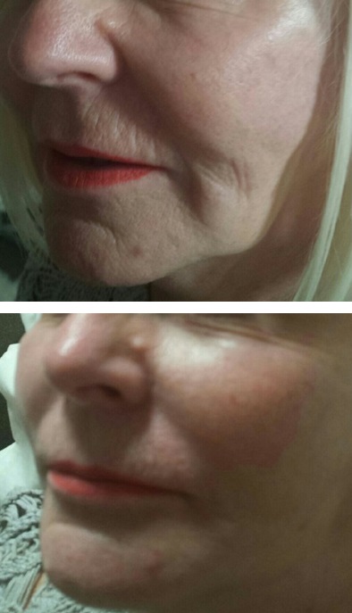 PDO Thread Lift and PRP Treatment Combined