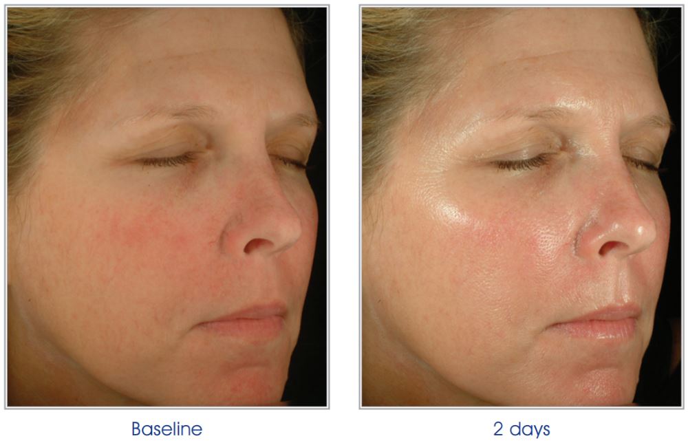 Obagi Blue Peel Before and After